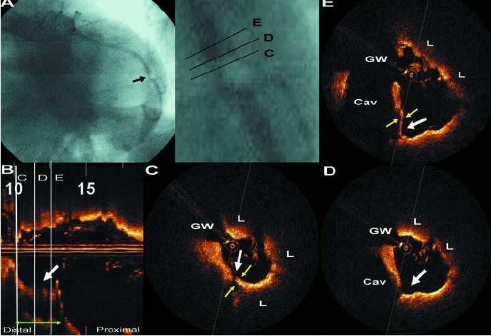 greater length of missing fibrous cap than NSTEMI