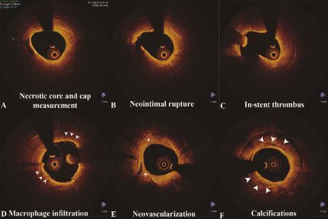 Neoatherosclerosis Neoatherosclerosis is frequent and more common among symptomatic patients. Importantly, neointimal rupture is associated with ACS late after stent implantation.