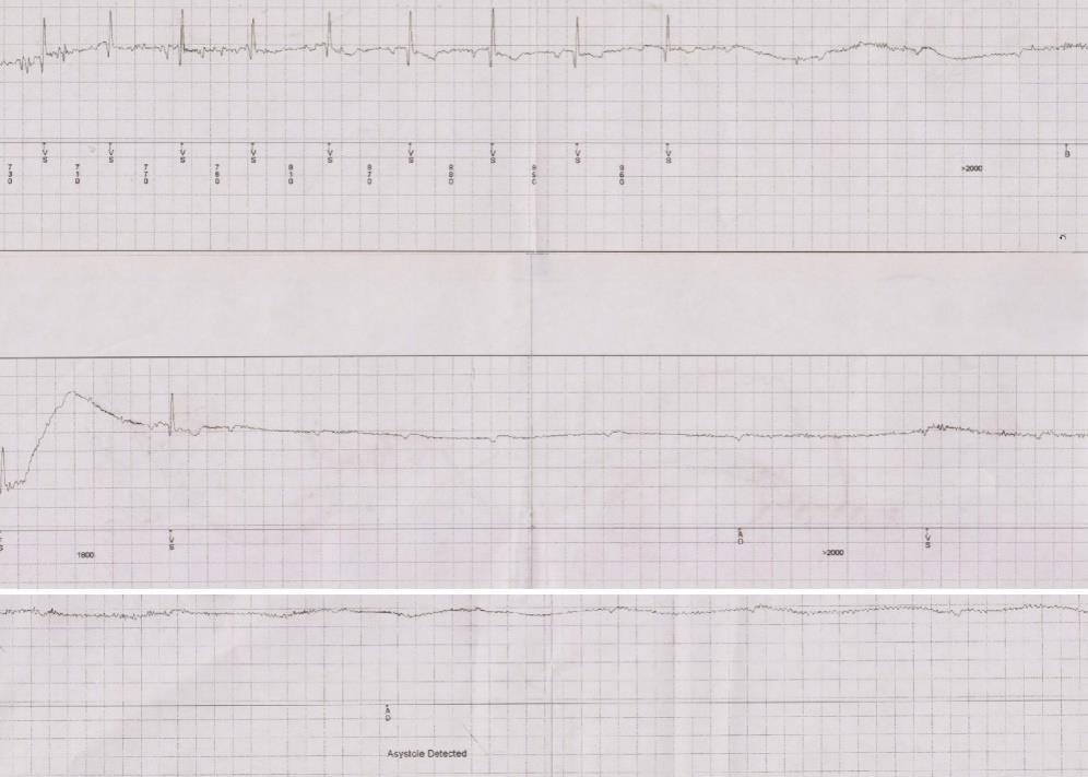 disease underwent an implantable loop recorder implantation for recurrent syncopal