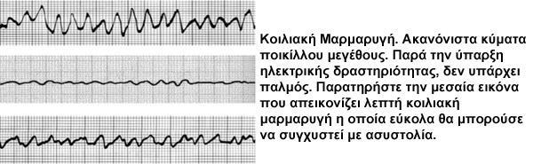 Η επιτυχής έκβαση της ΚΑΡΠΑ επί Κοιλιακής Μαρμαρυγής / Άσφυγμης Κοιλιακής Ταχυκαρδίας καθορίζεται από τον χρόνο εφαρμογής της απινίδωσης.