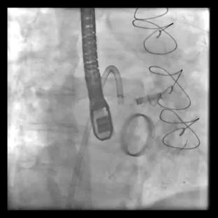 AGILIS CATHETER