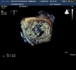 Conclusion Patient made full recovery 12 months post procedure is symptom free, NYHA I without hemolysis Paravalvular leak closure is often a complex