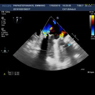 2 PARAVALVULAR