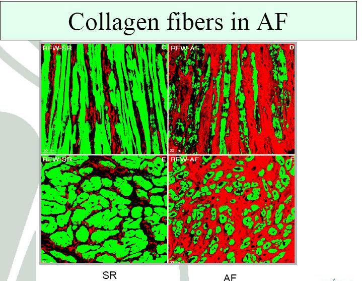 Therefore, myocardial conductivity values in the fibrotic regions are reduced by 20% in the longitudinal direction and 50% in