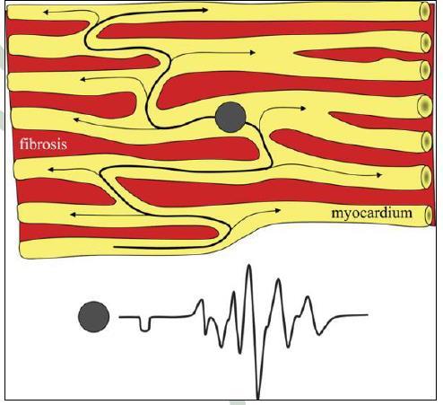 Circulation 2003;108:1461 1468. Sanders P, et al. Circulation 2004;109:1514 1522. Roberts-Thomson KC, et al. Heart Rhythm 2009;6:1000 1006. Dimitri H, et al.