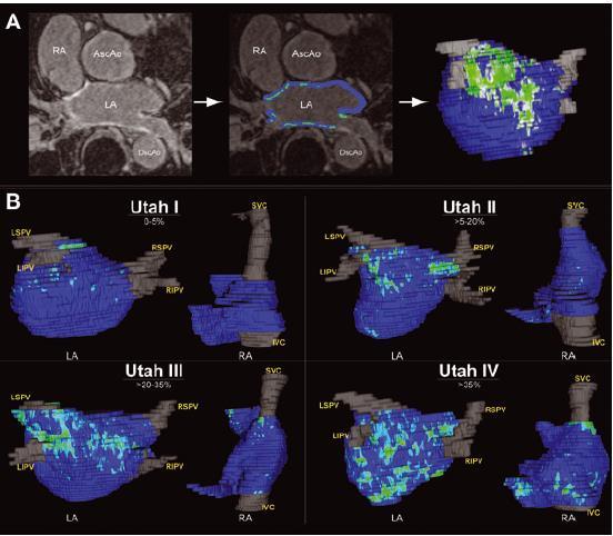 Br Heart J 1978 In patients with AF presenting for catheter ablation, LGE-MRI quantification of atrial fibrosis demonstrates preferential LA involvement.