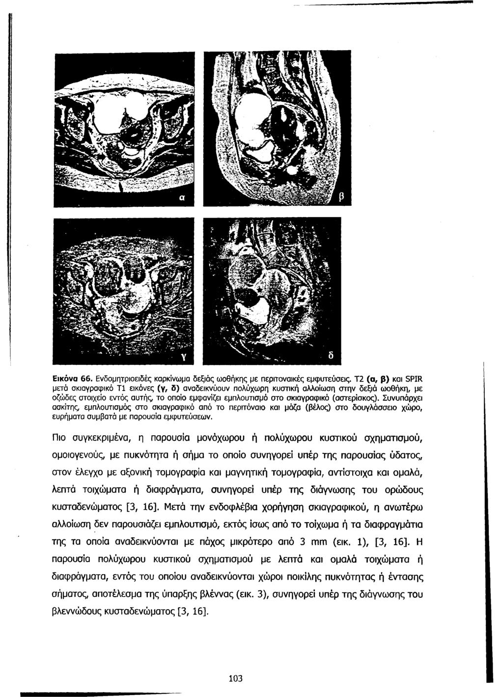 Ε ικόνα 66. Ενδομητριοειδές καρκίνωμα δεξιάς ωοθήκης με περιτοναικές εμφυτεύσεις.