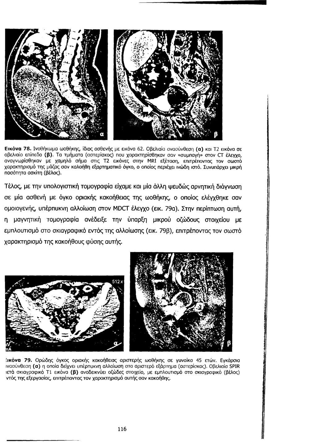 Εικόνα 78. Ινοθήκωμα ωοθήκης, ίδιος ασθενής με εικόνα 62. Οβελιαία ανασύνθεση (α) και Τ2 εικόνα σε οβελιαίο επίπεδο (β).