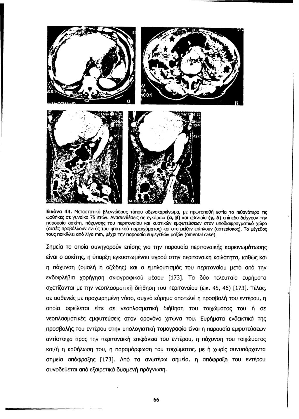 Εικόνα 44. Μεταστατικό βλεννώδους τύπου αδενοκαρκίνωμα, με πρωτοπαθή εστία το πιθανότερο τις ωοθήκες σε γυναίκα 75 ετών.