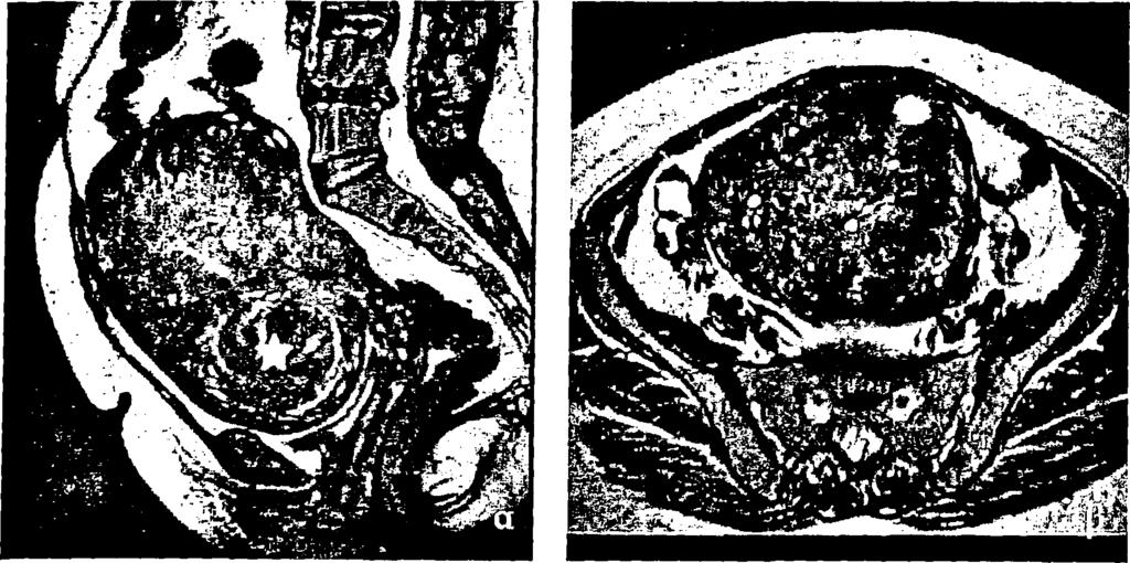 εικόνες, το ελλειψοειδές σχήμα και η απουσία έκδηλων πιεστικών φαινομένων επί της κοιλότητας της μήτρας [126, 241]. Εικόνα 53.