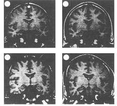 Οι κυρίαρχες νευρανατομικές υποθέσεις στη σχιζοφρένεια είναι οι υποθέσεις του προμετωπιαίου φλοιού και του μεταιχμιακού συστήματος.