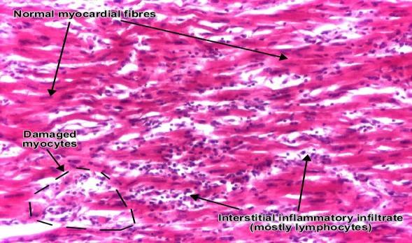 Миокардитын морфологи