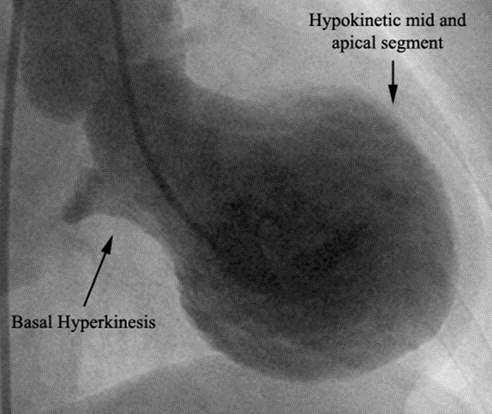Cauze: EPA cardiogen Insuficienţa VS (şi cardiomiopatia Takotsubo) IMA/ ischemia miocardică (şi după SCR) Complicaţiile IMA (ruptură de sept, muşchi papilar) Boli valvulare severe stenoze aortice sau