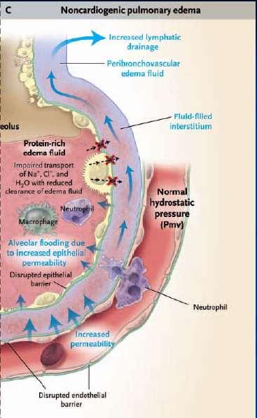 ALI/ ARDS proteine şi fibrină membrane hialine difuziunii de O 2 Edemul pulmonar necardiogen Leziuni ale epiteliului