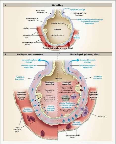 Definiţie Acumulare de fluide în interstiţiul pulmonar şi spaţiul alveolar extravazarea de fluide > reabsorbția de lichide prin căile limfatice
