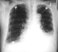 EPA cardiogen Radiografic Voalare difuză, bilaterală Cardiomegalie Liniile Kerley
