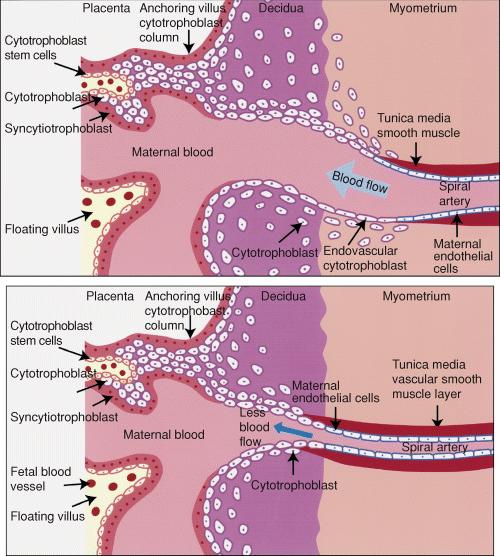 placental vasculopathy villous infarcts. multiple infarcts.