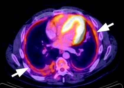 Chest 2015;147:502-12 Ψευδώς (+) σε καλοήθεις καταστάσεις (λοιμώξεις, ουραιμική,