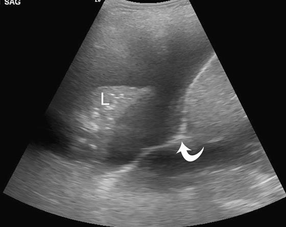 Ultrasound Med Biol 2009;35:1468-74