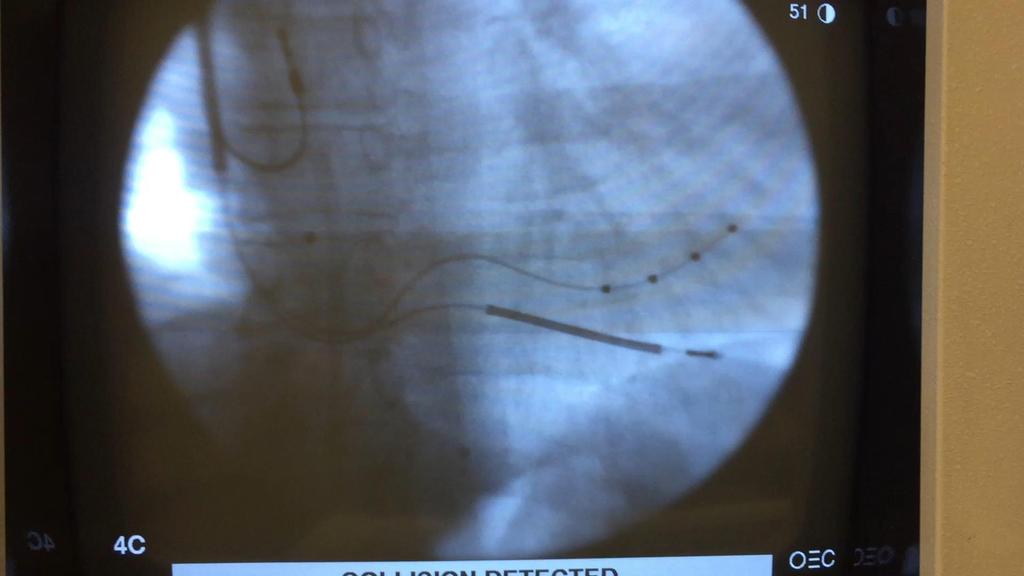 During CRT Implantation