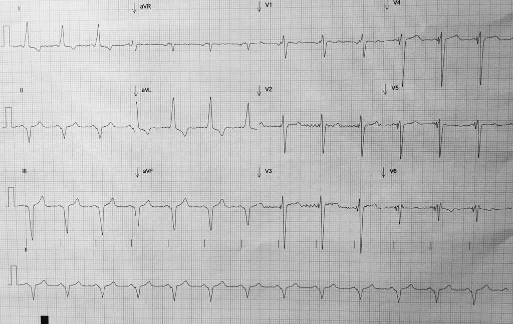 ECG: