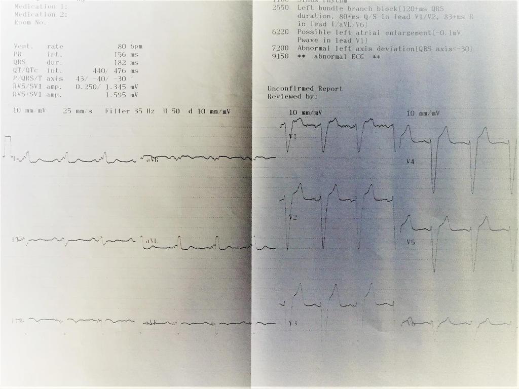 Baseline ECG: SR