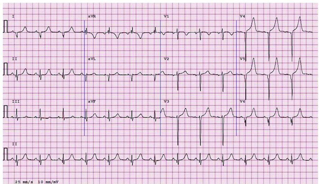 ECG from an 18-year-old female swimmer demonstrating deep and wide pathological Q waves in V4-V6, I and avl.