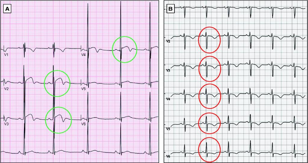 T-wave inversion From: International recommendations for electrocardiographic interpretation in athletes Eur Heart J. Published online February 20, 2017. doi:10.