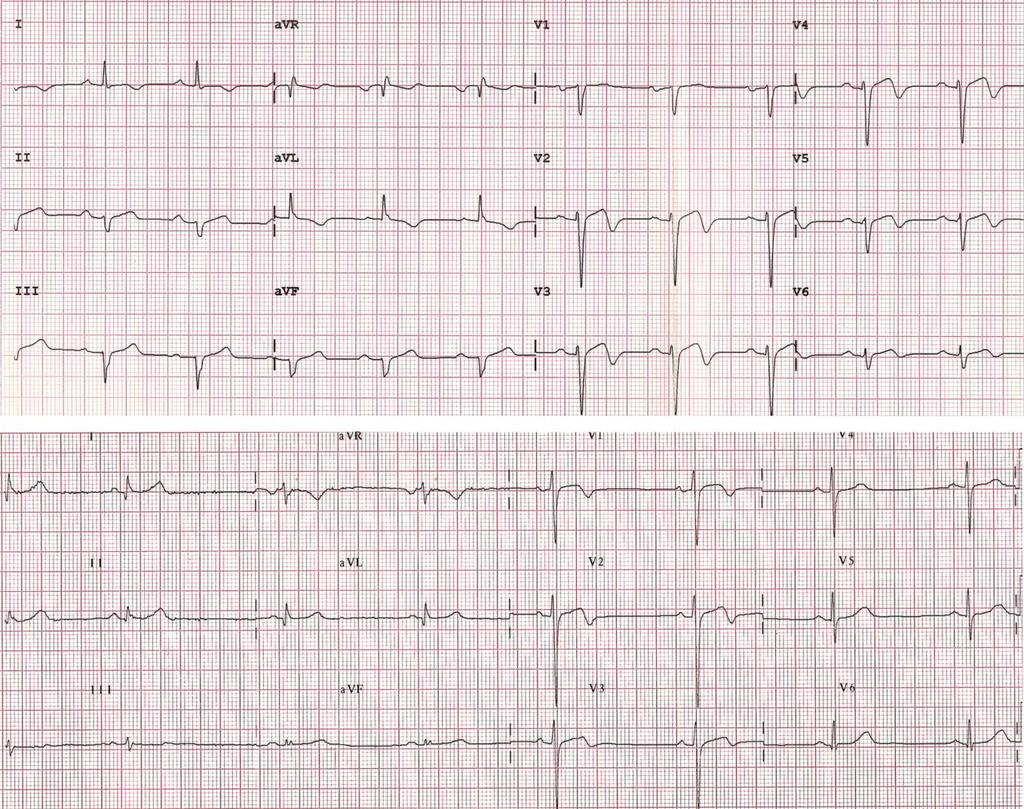 electrocardiographic anterior T-wave inversion in Athletes of different ethnicities: differential diagnosis between athlete's heart and cardiomyopathy From: Electrocardiographic anterior T-wave