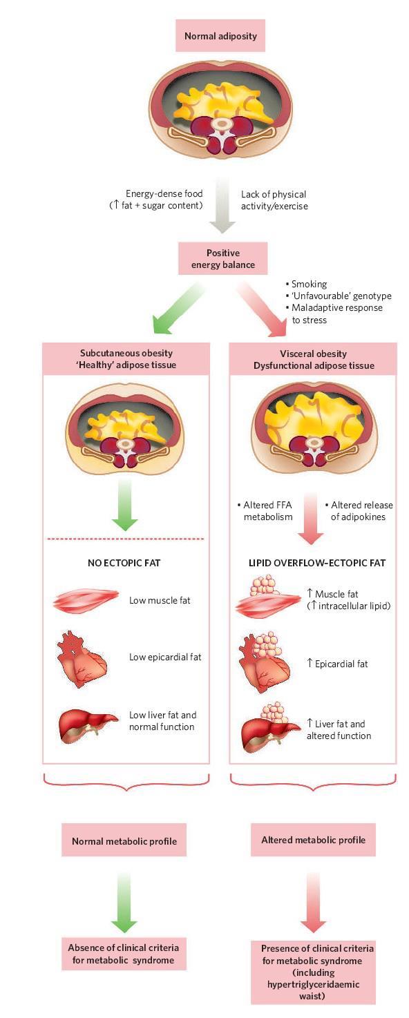 Εικόνα: Η συσσώρευση λίπους και η έκτοπη εναπόθεση λίπους στα σπλάχνα προκαλεί