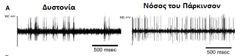 Εικόνα 18: Mορφή και ρυθμός της εκφορτιστικής δραστηριότητας των βασικών γαγγλίων στη φυσιολογική κατάσταση και στη νόσο πάρκινσον στη διάρκεια ενός δευτερολέπτου Εικόνα 19: Μορφή και συχνότητα της