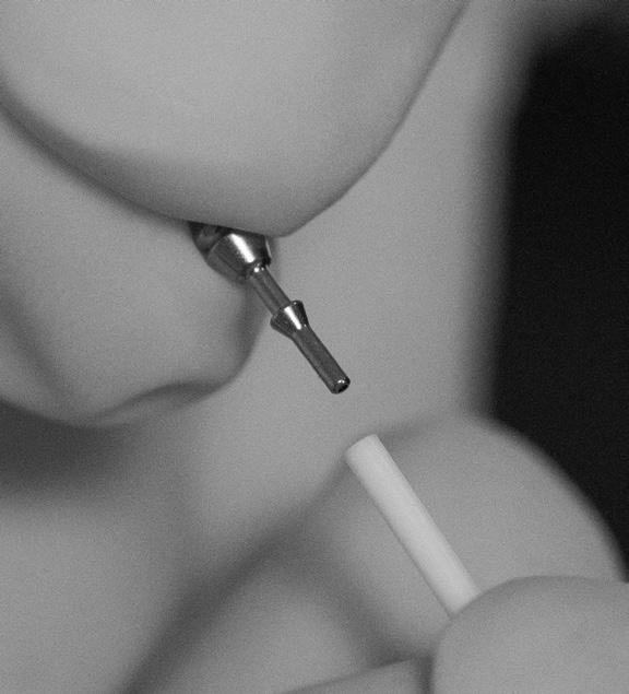 Οδηγίες εμφύτευσης Συνδέστε το τμήμα στον καθετήρα 10. Εισαγάγετε το άλλο άκρο του συνδέσμου του καθετήρα μέσα στο εγγύς άκρο του εμφυτευμένου καθετήρα.
