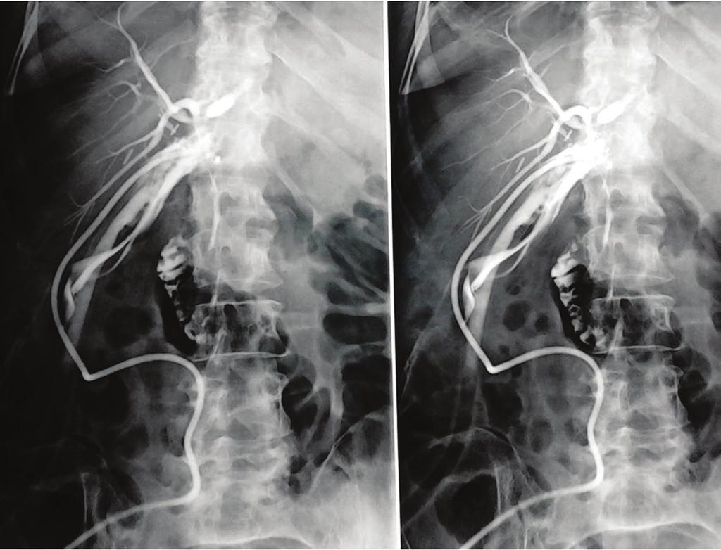 We present our experience of more than 20 years with 5456 LCs, and we describe the biliary injuries sustained during the procedure and their management.