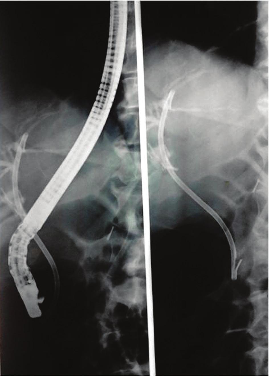 146 E. Perrakis et al. Figure 3. ERC and stent. leakage enabled its removal in 2-6 weeks.