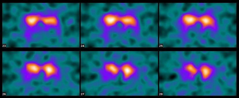 DaT SPECT σε Πρώιμο Ημιπαρκινσονισμό & Προκλινική Διάγνωση ΠΕΡΙΣΤΑΤΙΚΟ 2 Άνδρας 30 ετών Τρόμος ΔΕ άνω άκρου, πρόσφατης έναρξης (ιδίως κατά την κόπωση) Φαρμ.