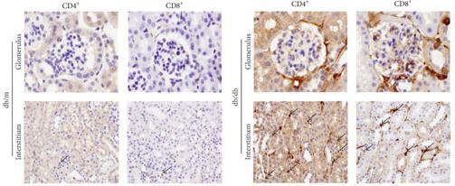 Τ λεμφοκύτταρα CD4, CD8 CD28+Β7-1 συσχέτιση με τη βαρύτητα της