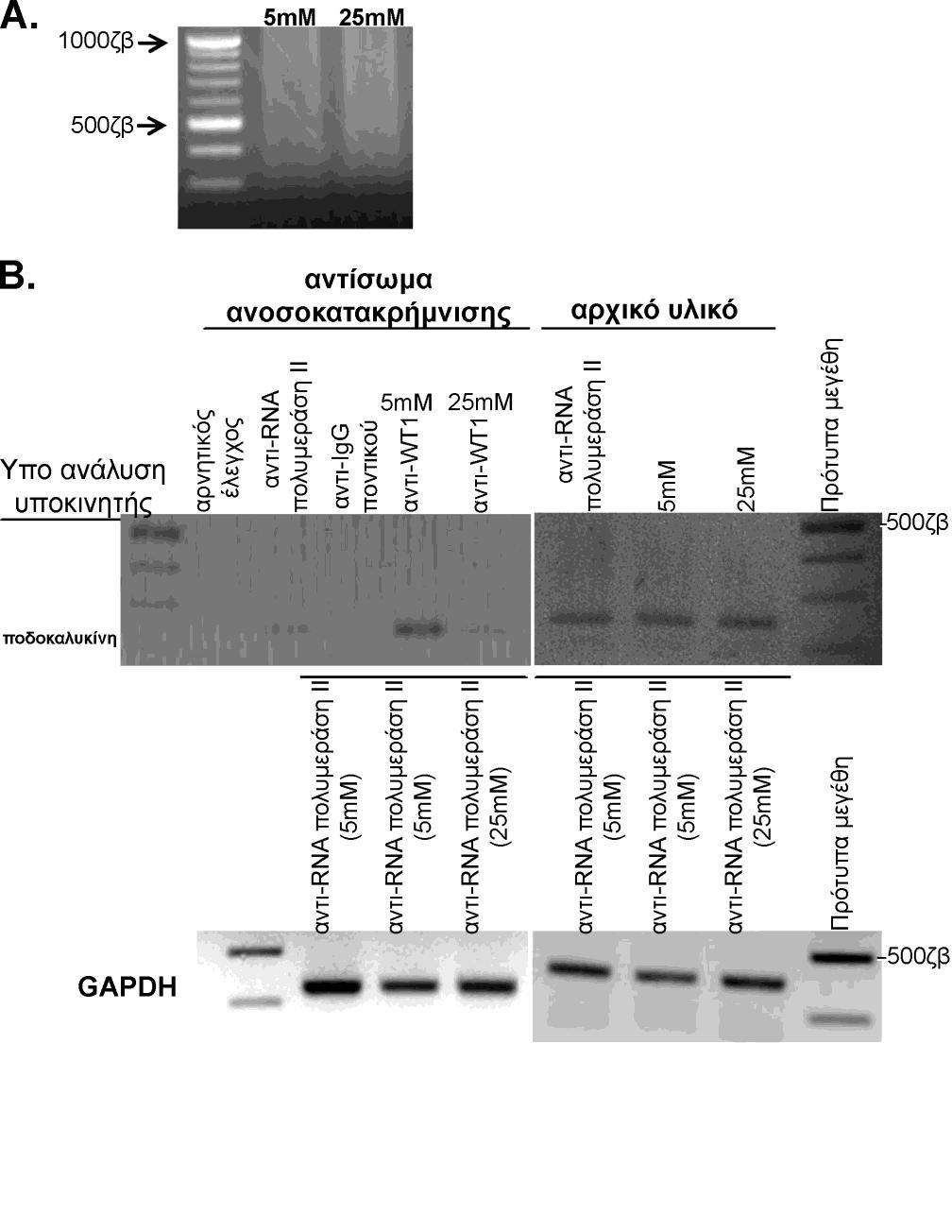 Σχήμα 15. Ανάλυση της πρόσδεσης του WT1 στον υποκινητή του γονιδίου της ποδοκαλυκίνης. HGEC που καλλιεργούνται συνεχώς υπό την παρουσία 5mM ή 25mM γλυκόζης μονιμοποιήθηκαν με φορμαλδεΰδη.