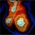 ACE Inhibitor Evidence: Secondary Prevention SAVE Radionuclide EF <40% AIRE Clinical