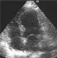 ACE-I=Angiotensin converting enzyme inhibitors, EF=Ejection fraction, LVSD=Left