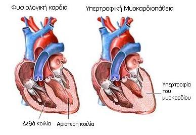 Υπερτροφική