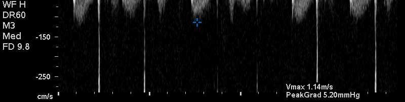 14 m/sec TR 