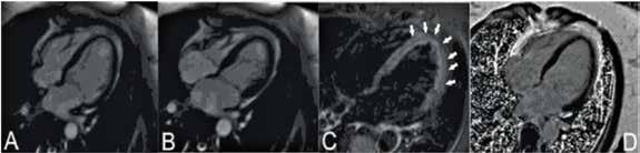 Η απουσία ενίσχυσης του γαδολινίου (LGE) παρατηρήθηκε σε 12 (67%) ασθενείς και σε έξι (33%) ασθενείς παρατηρήθηκε διακεκομμένη LGE σε νοσούντα τμήματα (γκρίζο μυοκάρδιο) (Πίνακας 3, Εικόνα 1)