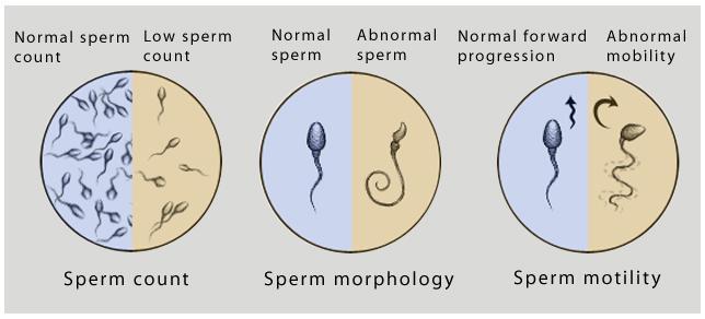 Εικόνα 1 Κλινικά Χαρακτηριστικά των σπερματοζωαρίων σε άτομα με αζωοσπερμία (http://www.iator.gr/2016/10/27/ti-ine-i-azoospermia/).