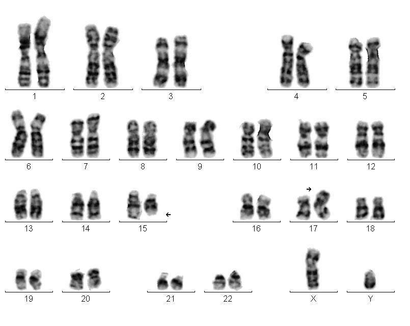 Εικόνα 6. 46,XY,t(15;17(q23 qter::p13 17pter).