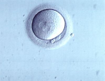 Προέλευση των Γενετικών Ανωμαλιών Ωάρια : Τα μακροβιότερα κύτταρα του ανθρώπου- μεγάλη καθυστέρηση από την 1η έως την ολοκλήρωση της 2ης μείωσης Σπερματοζωάρια : Οξειδωτικό στρες-