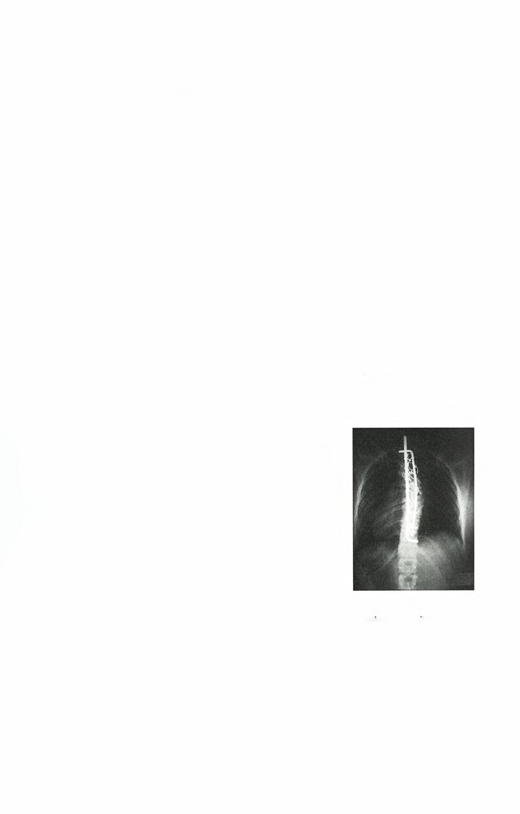 4.2 Σύστημα Harrington με υποπετάλια σύρματα (Moe s modification) Ο προβληματισμός των χειρουργών για τη λύση των παραπάνω προβλημάτων, οδήγησε στην τμηματική σπονδυλοδεσία συνδυάζοντας το σύστημα