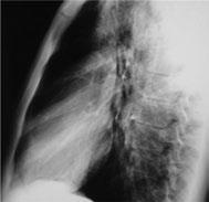 - pneumomediastinum A 24 year-old man who was a professional diver, smoked 10 cigarettes per day and had a negative medical history, performed a free-diving descent to a depth of 13 meters under the