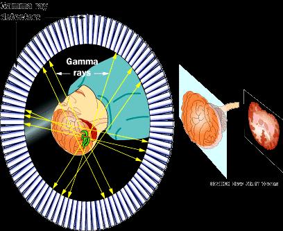 Τι είναι η Ποζιτρονική Τομογραφία (ΡΕΤ) Τα φωτόνια εκπέμπονται σε