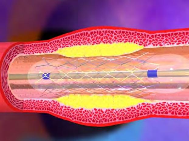 Εικόνα 5.3.. Παραπάνω απεικονίζεται ένα stent που απελευθερώνει φάρμακο. Τα stents τέτοιου τύπου χορηγούν στον οργανισμό φάρμακα που διακόπτουν τις βιολογικές διαδικασίες που προκαλούν επαναστένωση.
