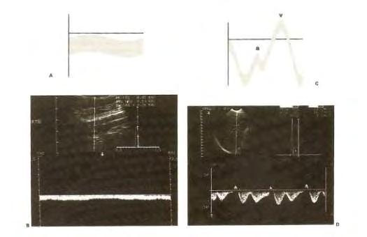 Εικόνα 5.4.1.1 Μεταβολές ροής οφειλόμενες στις μεταβολές πιέσεως στις δεξιές κοιλότητες της καρδιάς 5.4. Φυσιολογική αρτηριακή ροή Η ροή στις αρτηρίες είναι πολύπλοκη.